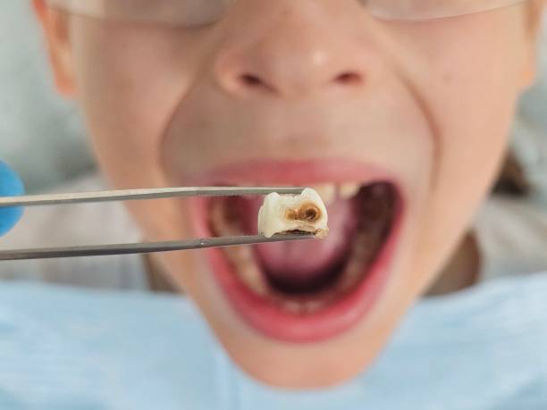 Best Emergency Tooth Extraction in Childress, TX