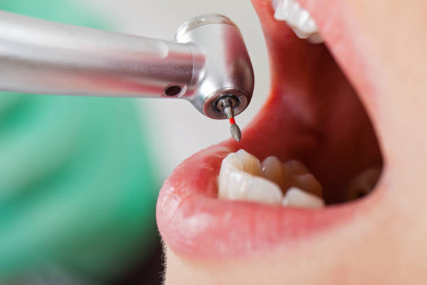 Best Emergency Wisdom Teeth Removal in Childress, TX